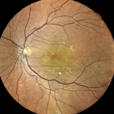 TrueColor retinal image of central serous chorioretinopathy (CSC)