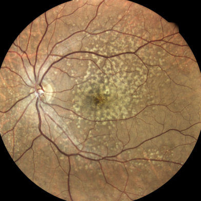 TrueColor retinal image of familial dominant drusen