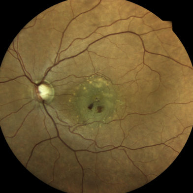 TrueColor retinal image of pigment epithelial detachment (PED) due to age-related macular degeneration (AMD)