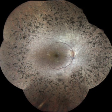 TrueColor mosaic retinal image of retinitis pigmentosa