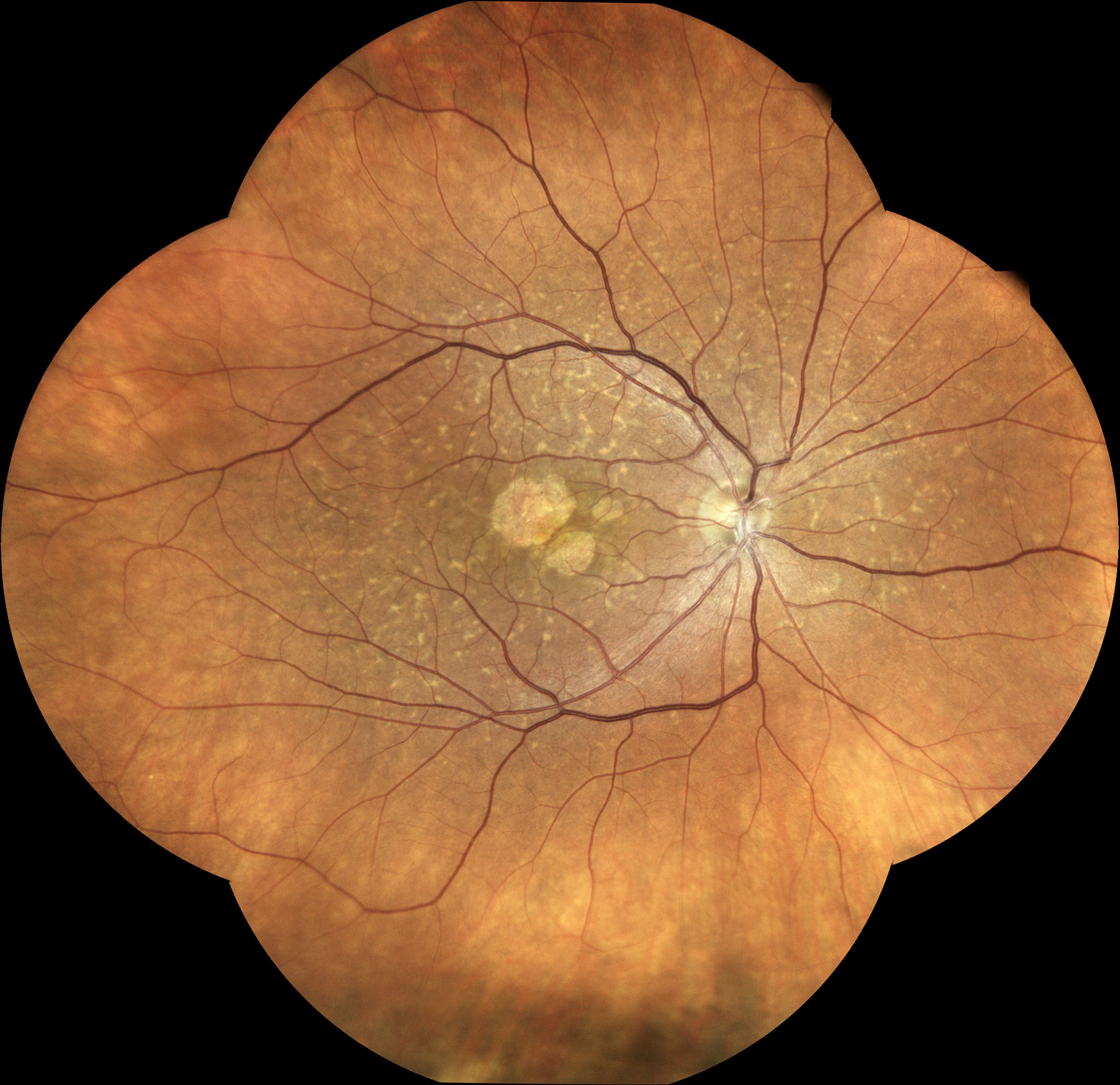 TrueColor mosaic retinal image of Stargardt disease