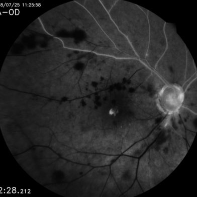 Ultra-high resolution retinal image taken with iCare EIDON FA