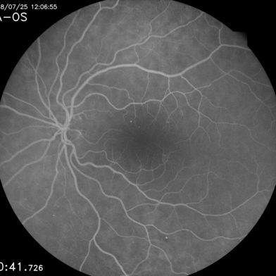 Ultra-high resolution retinal image taken with iCare EIDON FA