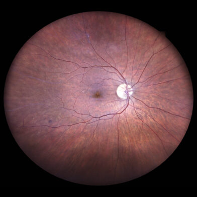 Diabetic retinopathy with microvascular dropout ischemia leakage and neovascularization