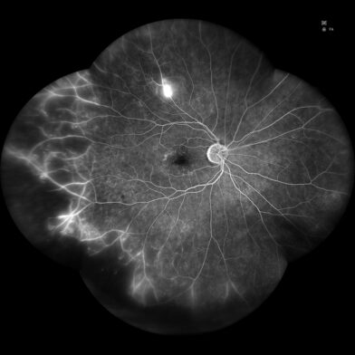 Diabetic retinopathy with microvascular dropout ischemia leakage and neovascularization FA