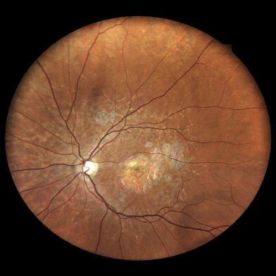 Stargardt disease-with-pigment mottling macular atrophy bulls eye maculopathy