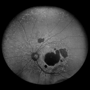 Stargardt disease with pigment mottling macular atrophy bulls eye maculopathy AF