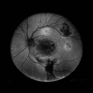 iCare fundus imaging devices